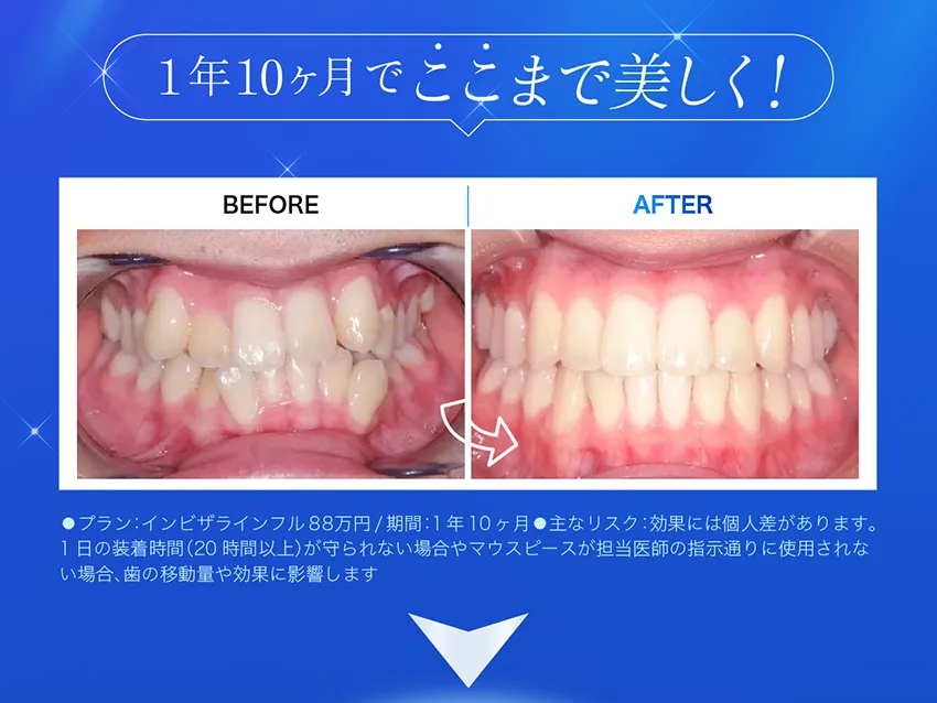 1年10月で美しくなった歯