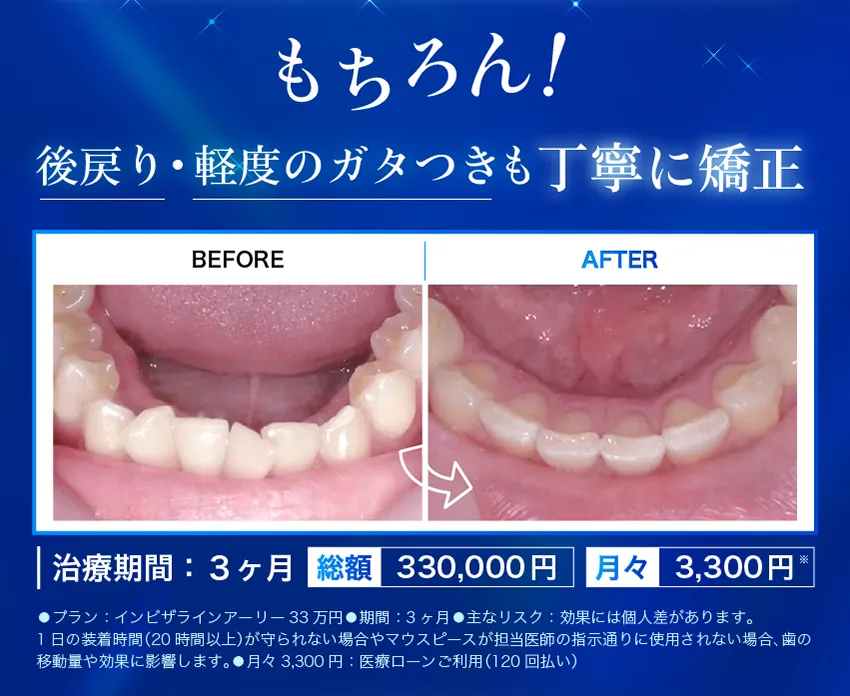 後戻り、軽度のガタつきも丁寧に矯正
