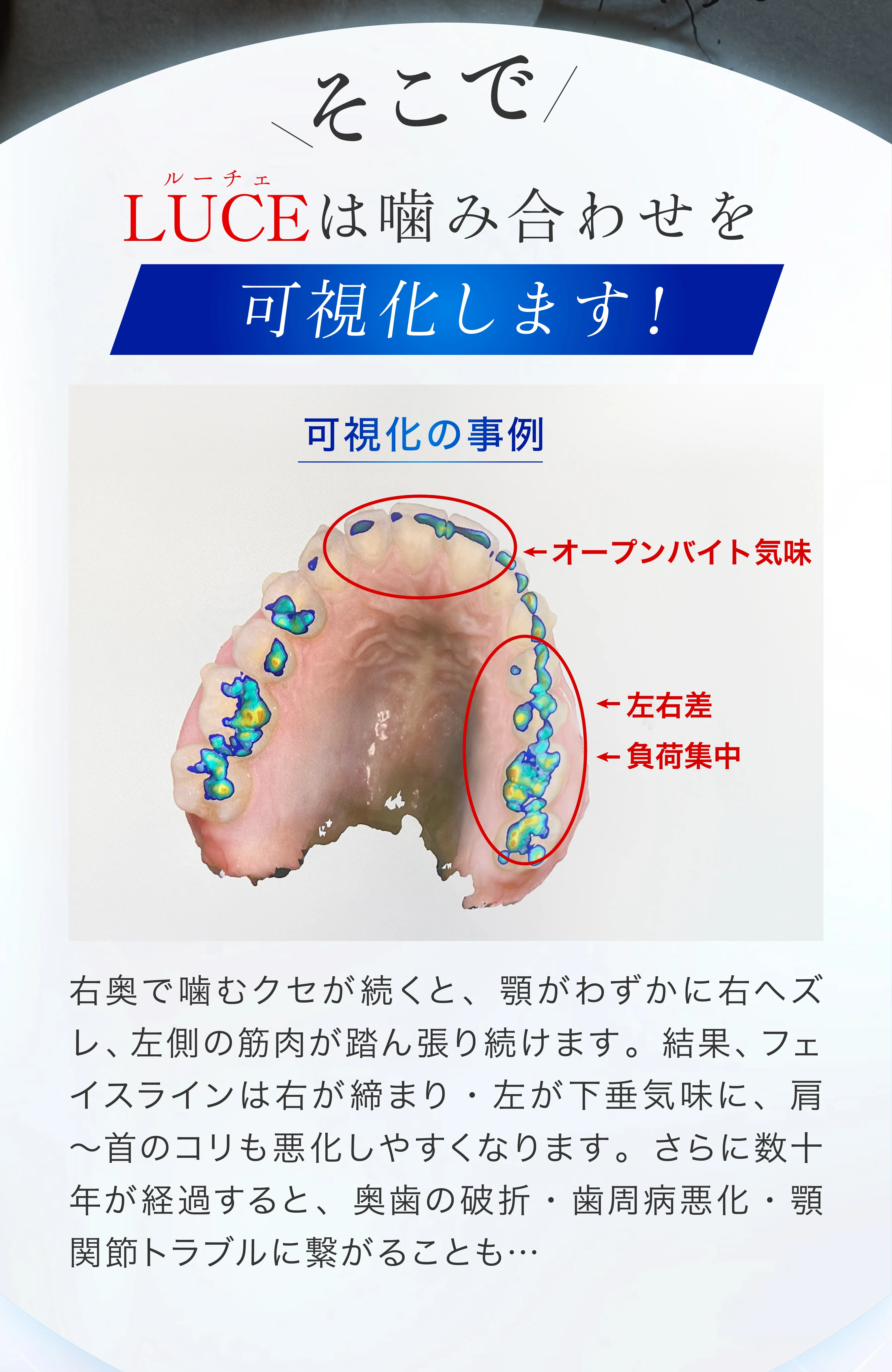 LUCEは噛み合わせを可視化