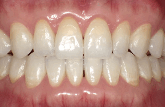 噛み合わせが悪い、歯に隙間が空いている方の矯正治療・症例写真