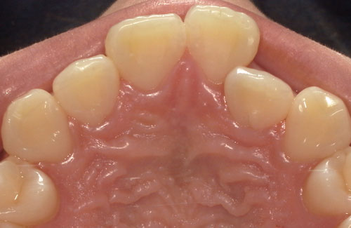 上の前歯が引っ込んでいる方の症例