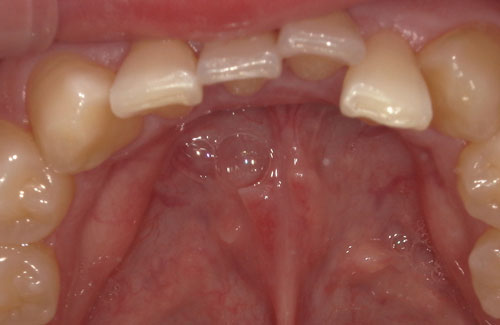 ２４回コース/期間１２ヶ月：ガタつき、出っ歯方の症例