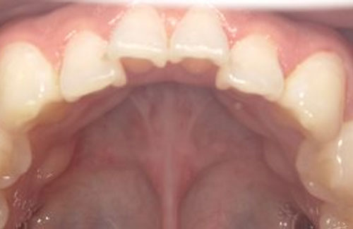 下顎前歯のガタガタな方の症例写真