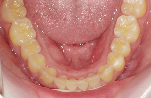 歯のガタガタ治療後（前歯下顎）