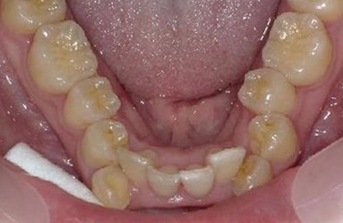 歯のガタガタ治療前（前歯下顎）