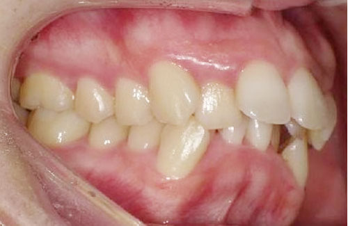 歯のガタガタ治療前（左側）