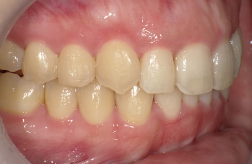歯のガタガタ治療後（左側）