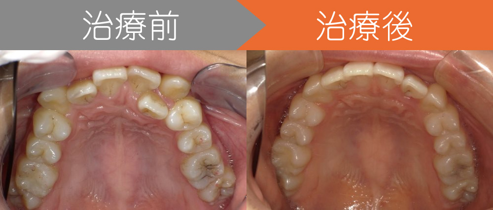 ＜症例8＞歯がガタガタで噛み合わせが悪くお悩みをマウスピース矯正で改善した症例写真