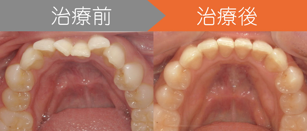 ＜症例3＞歯が全体的にガタガタ、出っ歯でお悩みお悩みをマウスピース矯正で改善した症例写真