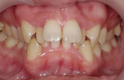 歯のガタガタ治療前（前歯）