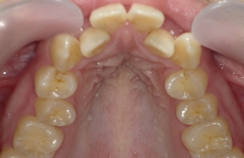 歯のガタガタ治療前（前歯上顎）