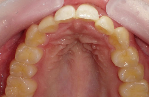 歯のガタガタ治療後（前歯上顎）