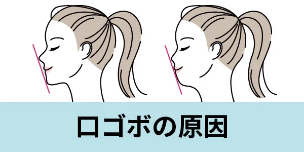 kuchigobo-1 | ルーチェマウスピース矯正歯科 口コボ 原因