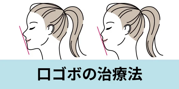 kuchigobo-3 | ルーチェマウスピース矯正歯科 口ゴボ 治療法