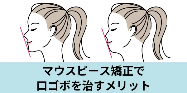 kuchigobo-5 | ルーチェマウスピース矯正歯科 口コボ マウスピース矯正