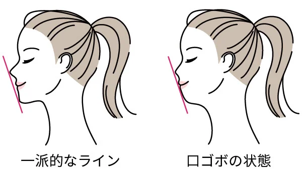 kuichi-gobo | ルーチェマウスピース矯正歯科 口ゴボ 一般 比較