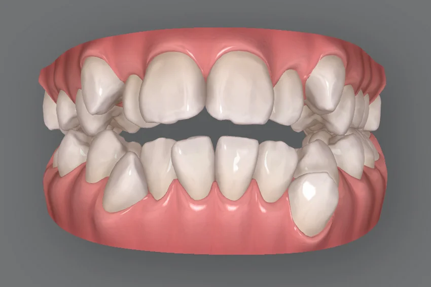 before | ルーチェマウスピース矯正歯科