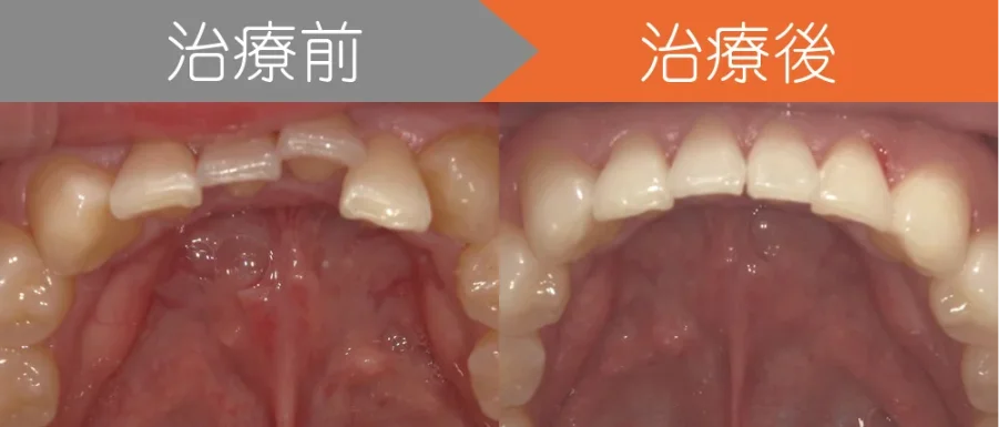 image | ルーチェマウスピース矯正歯科 上下の前歯がガタつき、出っ歯でお悩みの方のインビザライン治療例