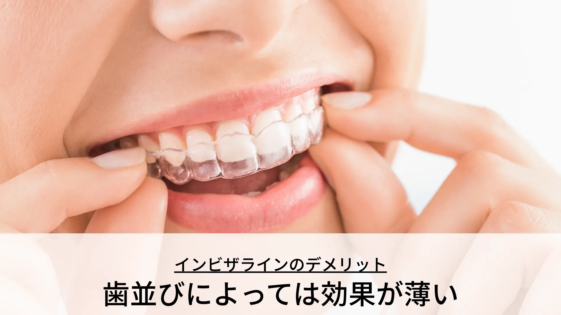 インビザラインのデメリット 歯並びによっては効果が薄い