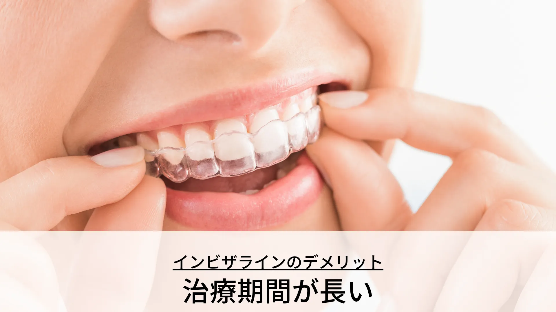 インビザラインのデメリット 治療期間が長い