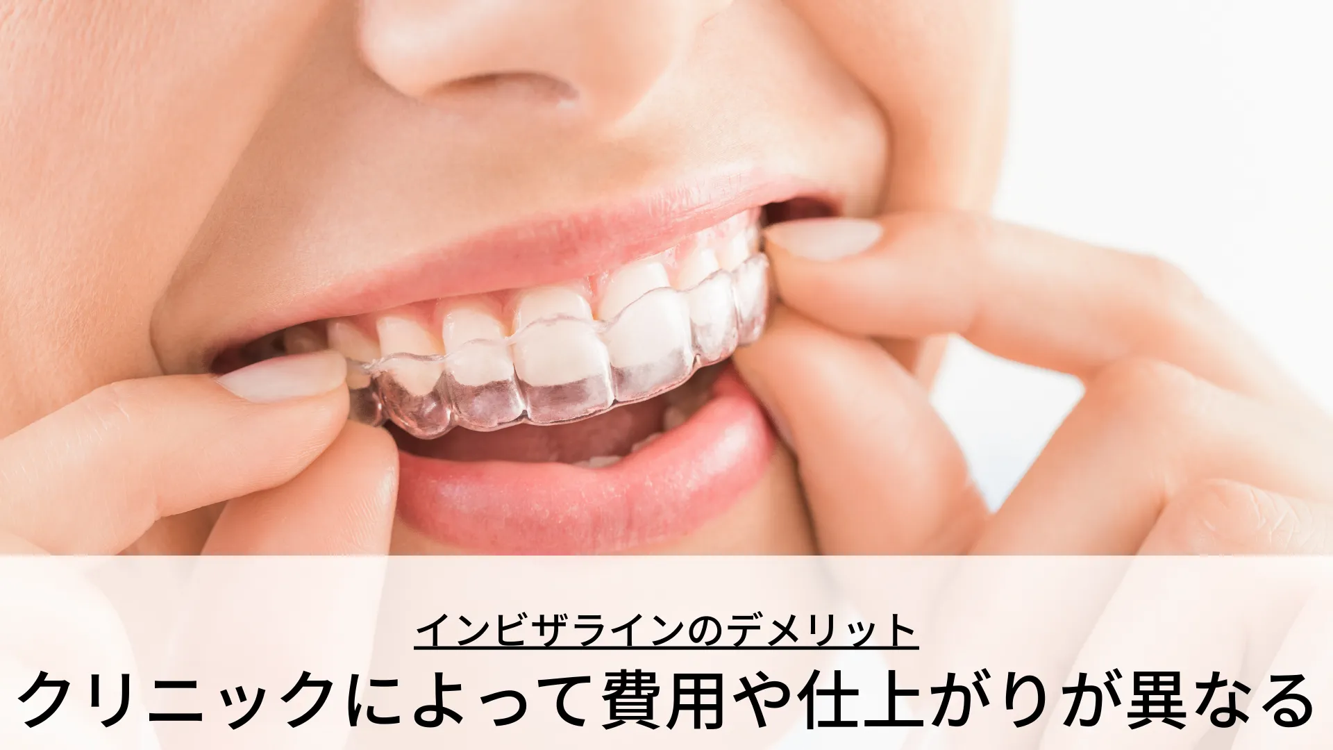 インビザラインのデメリット クリニックによって費用や仕上がりが異なる