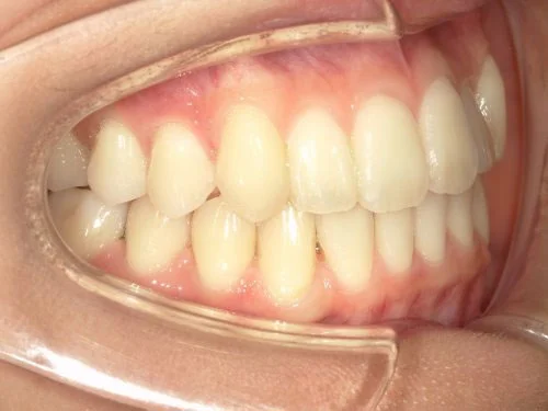 治療後前歯下顎