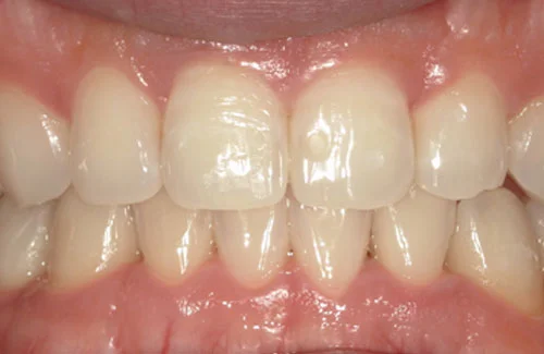 治療後上の歯がきれいに揃いました