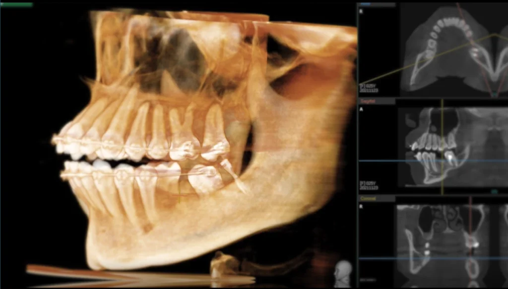 CTによる精密な歯列設計