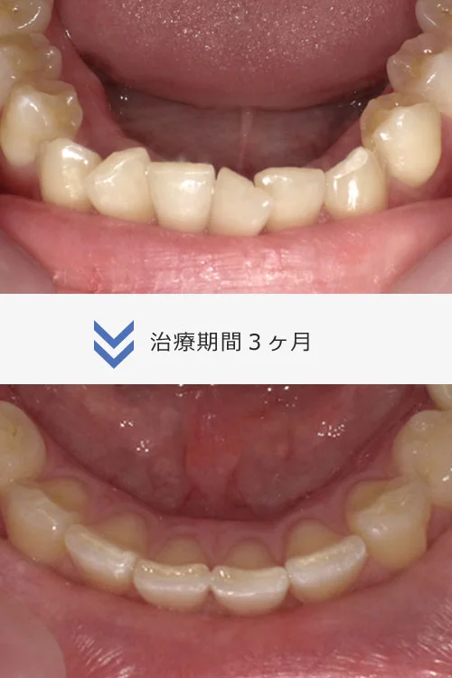 ８枚コース/Invisalign アーリー
約３ヶ半月〜４ヶ月
治療費 ３３万円