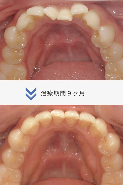 ２６枚コース/Invisalign モデレート
約６ヶ月〜９ヶ月
治療費 ６６万円