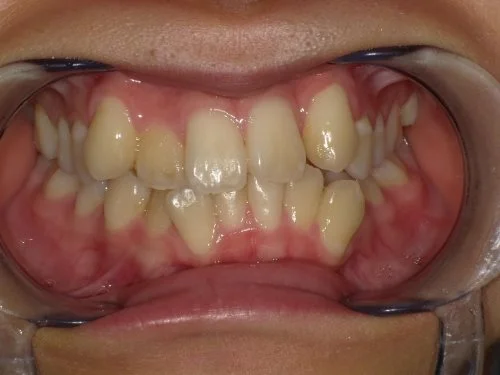 治療前前歯上顎