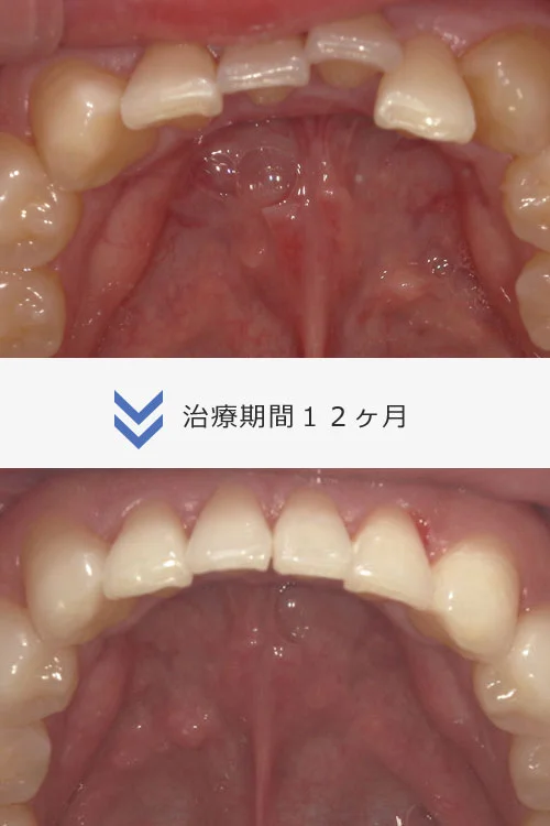 Invisalign フル１プラン
９ヶ月〜１年３ヶ月
治療費 ８８万円