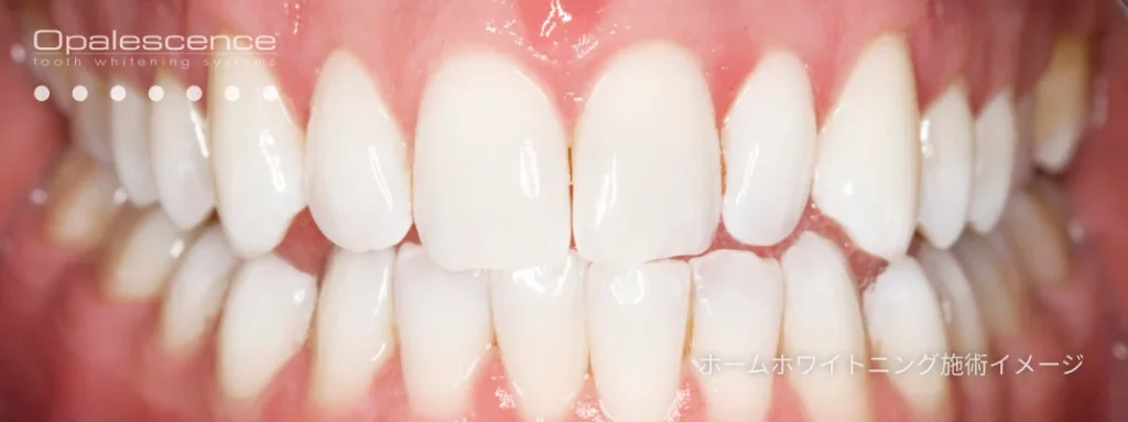 医療ホワイトニングとは？