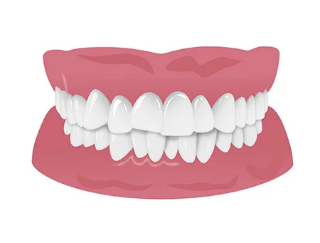 歯並びがデコボコ（叢生）