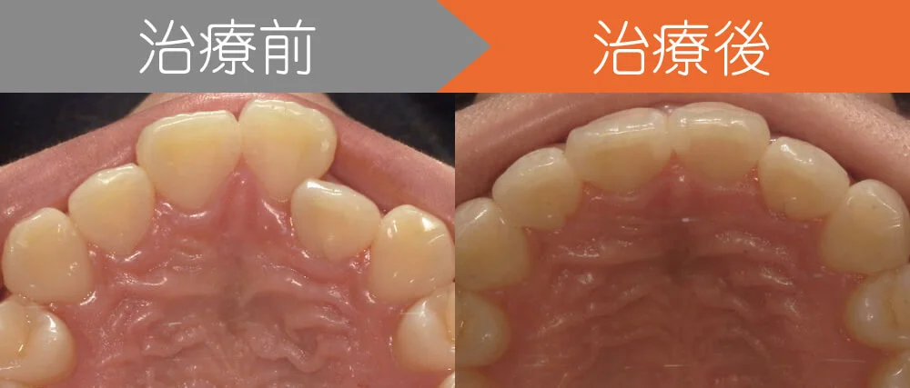 ＜症例３＞前歯のクロスバイトでお悩み
