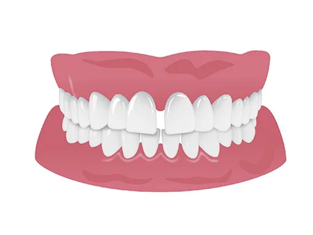 すきっ歯（正中離開）