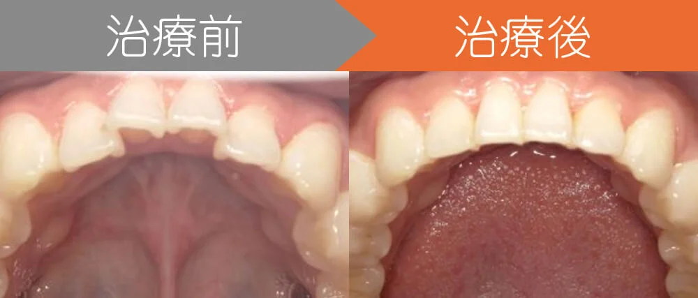 ＜症例４＞下の前歯がガタガタでお悩み