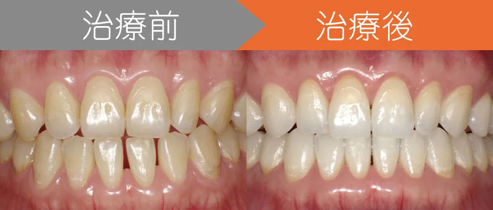 ＜症例６＞下の前歯が上の前歯よりも前に出ている・しゃくれ・すきっ歯でお悩み