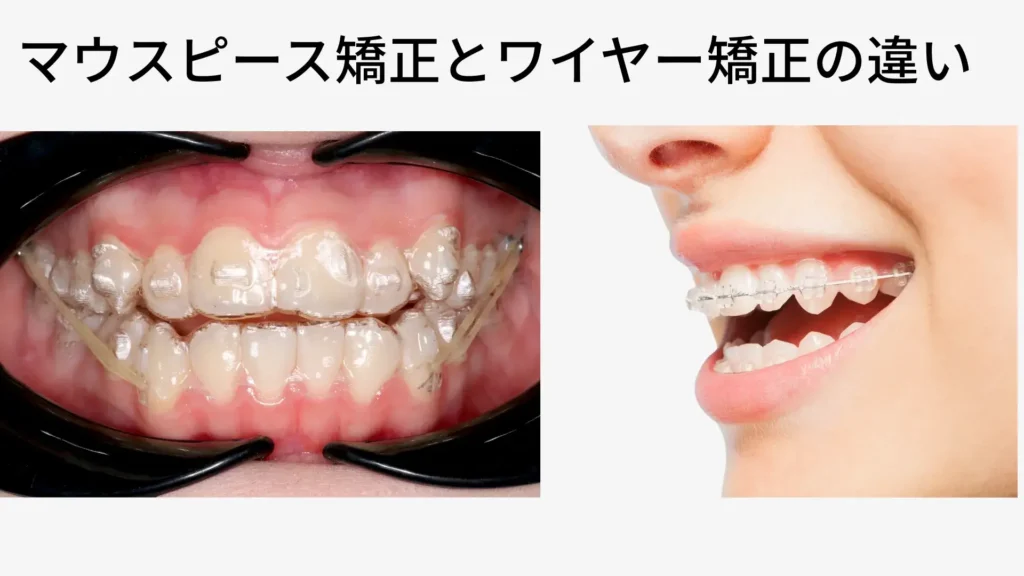 マウスピース矯正とワイヤー矯正の違い