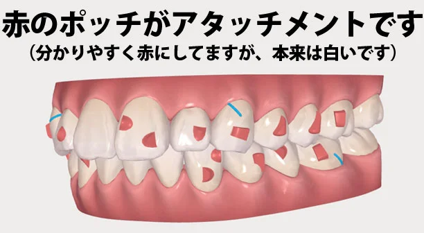 インビザライン矯正の歯を動かす仕組みについて