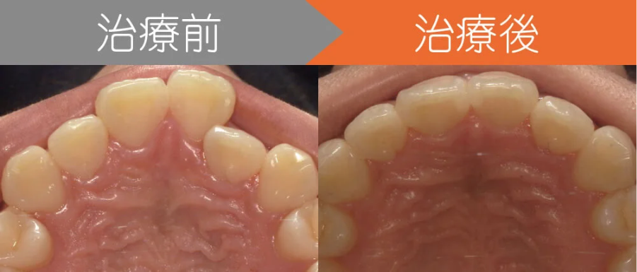 インビザラインの治療前後写真