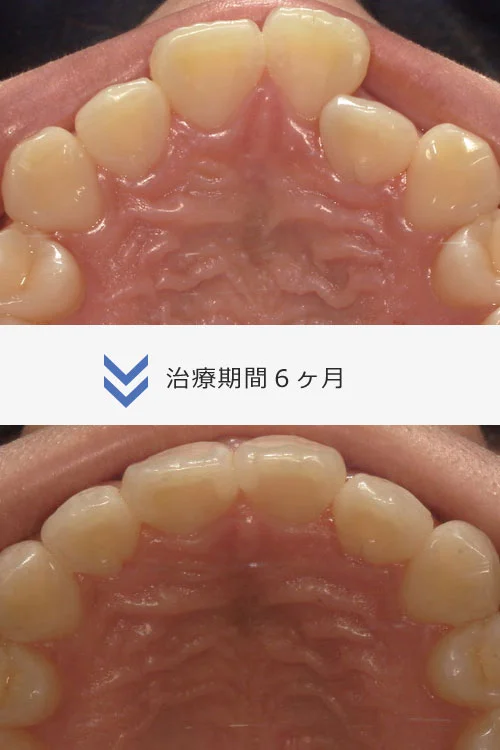 image | ルーチェマウスピース矯正歯科 軽度から中等度の歯並びの異常