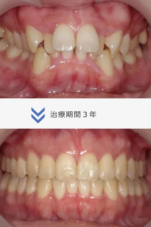 image | ルーチェマウスピース矯正歯科 重度の歯並びの異常