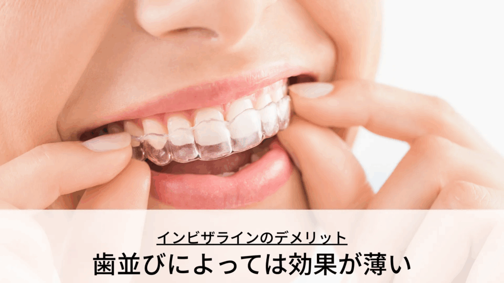 image | ルーチェマウスピース矯正歯科 歯並びによっては効果が薄い