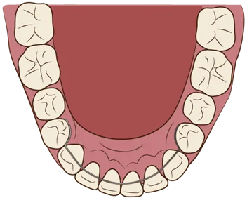 固定式のリテーナー