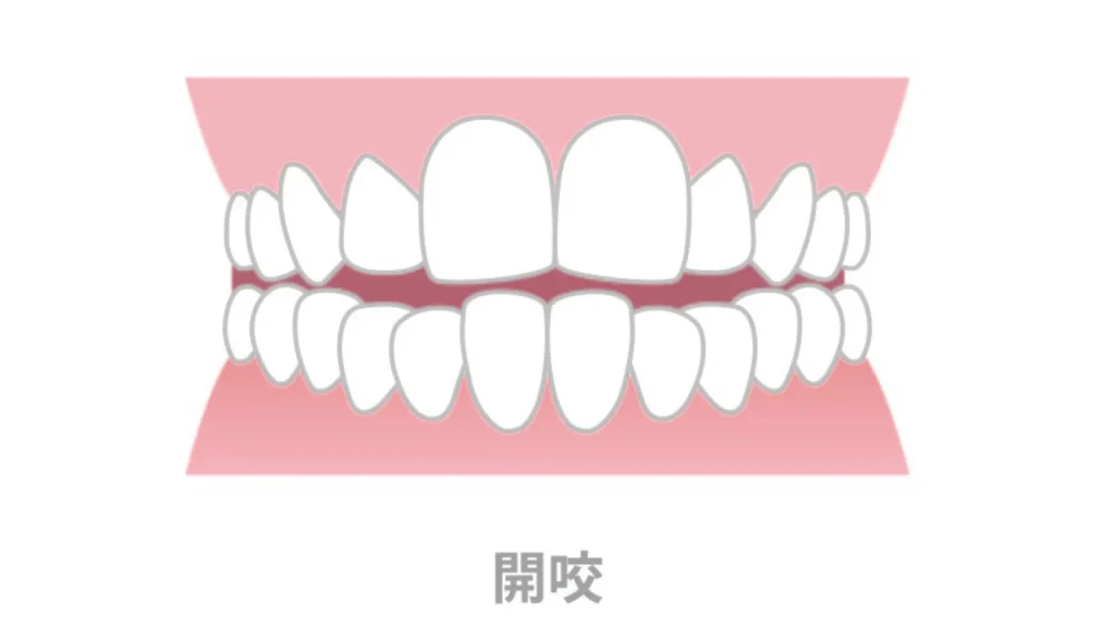 開咬（オープンバイト）とは