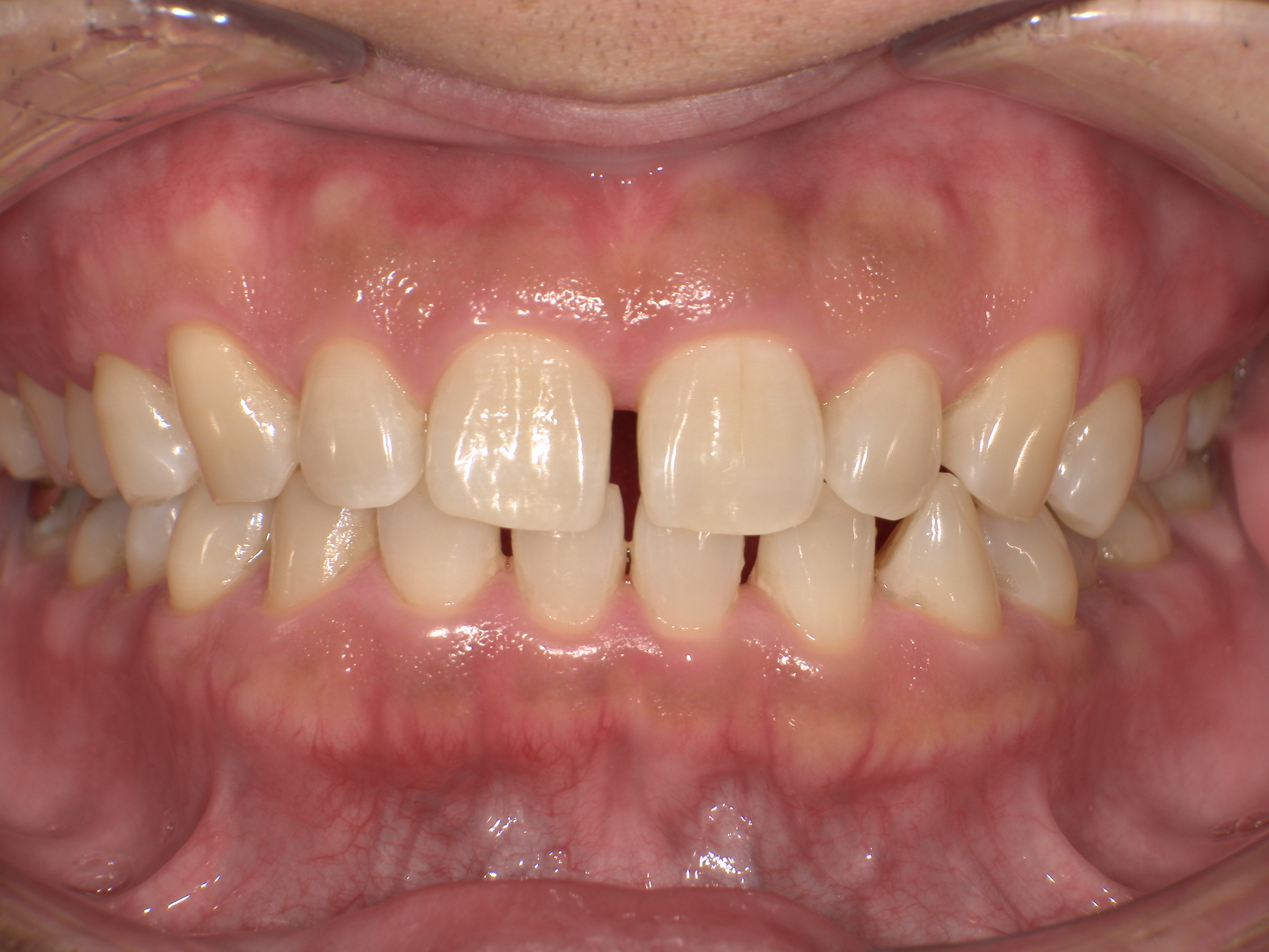 【治療前】前歯のすきっ歯がきになる。(男性/40代)の口元