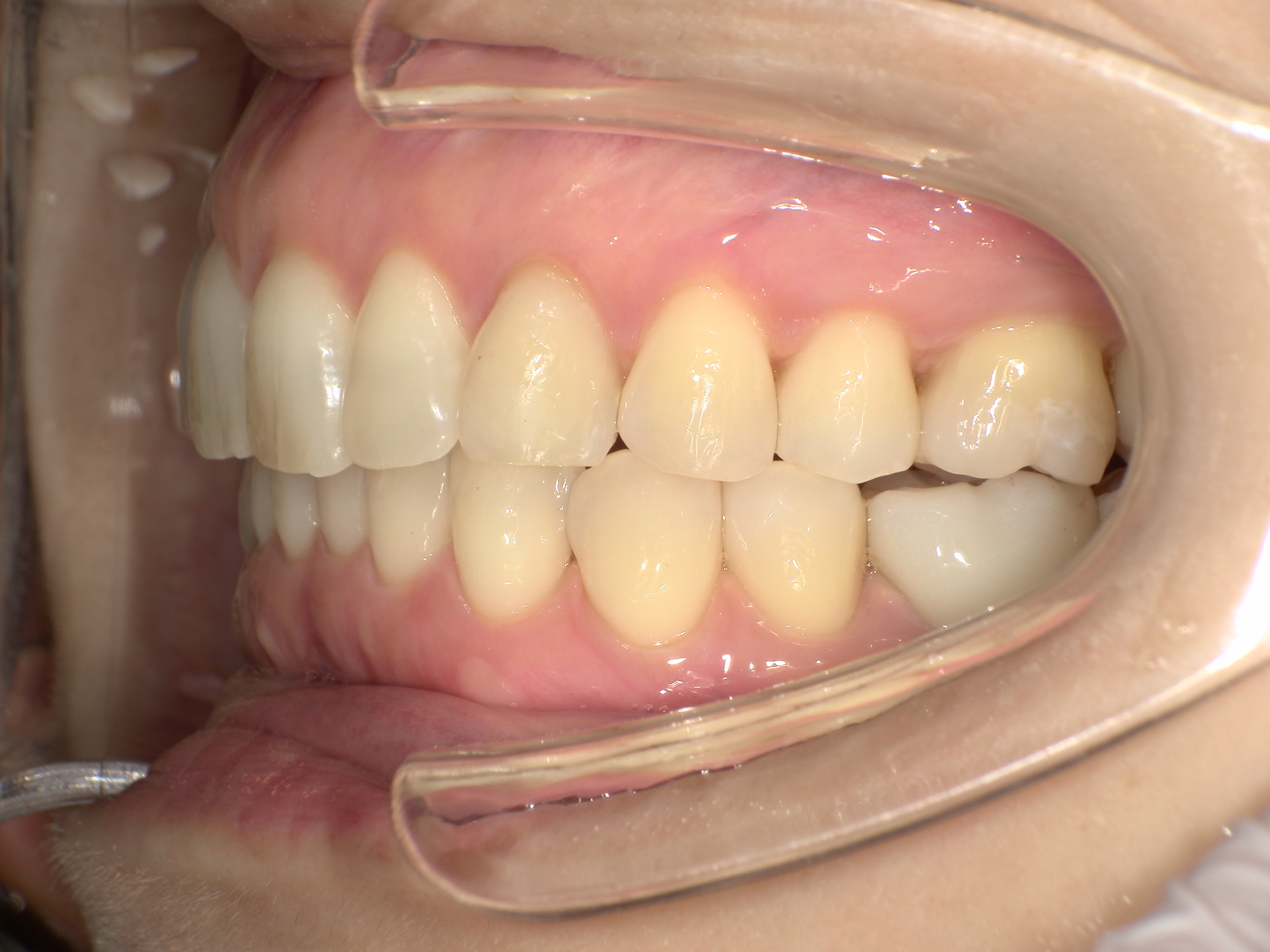 【治療後】上の歯が出ている(女性/40代)の口元