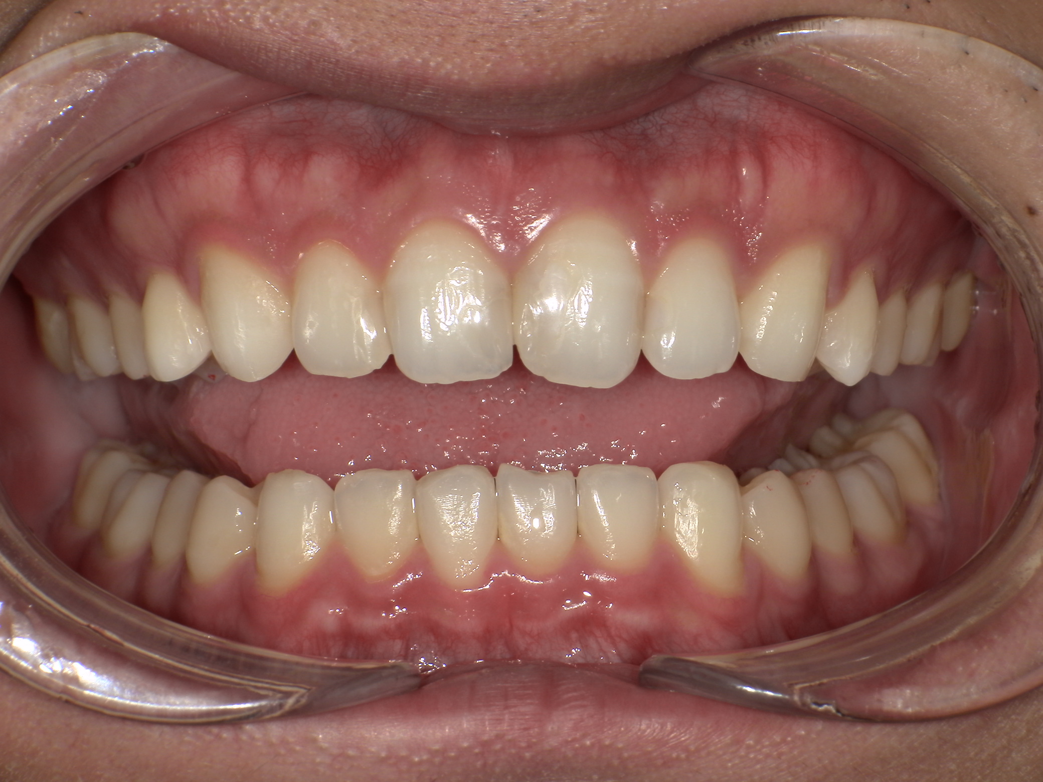 【治療後】歯並びがデコボコしている・前歯の中心のずれが気になる(男性/20代)の口元