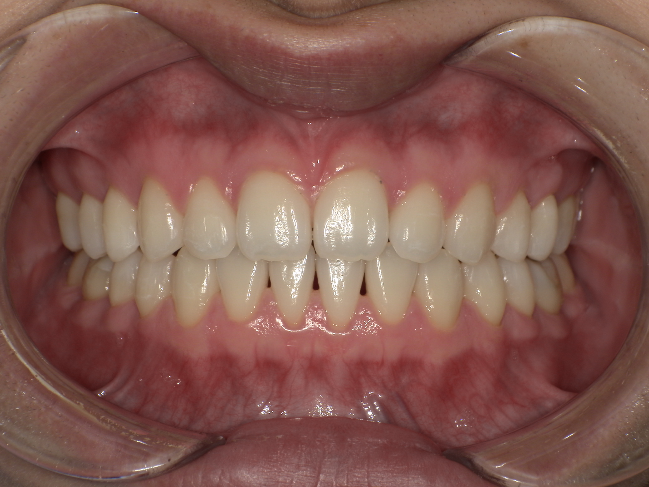 【治療後】すきっ歯気になる(女性/20代)の口元